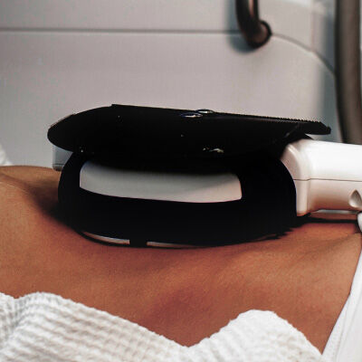 cryolipolysis