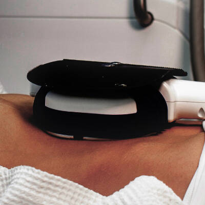 cryolipolysis
